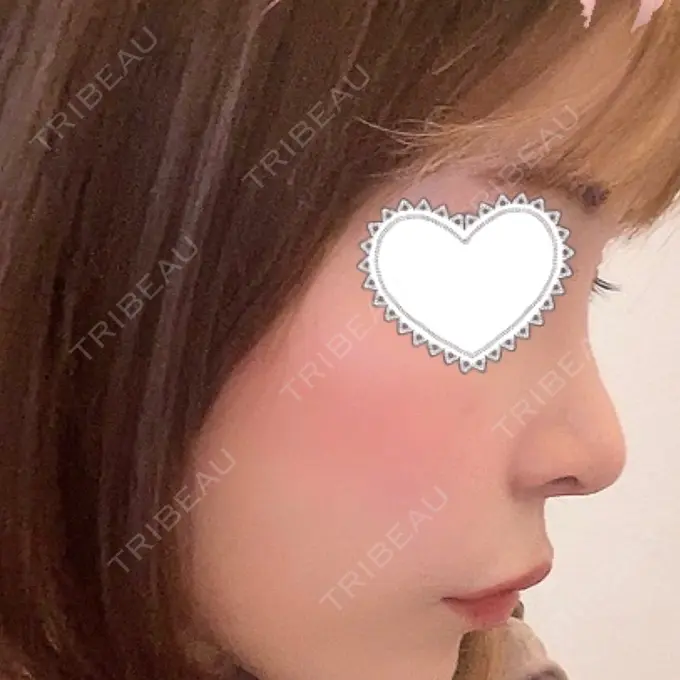 隆鼻術 / 鼻尖形成（切開） / 鼻中隔延長（切開） / 軟骨移植 / 鼻修正 LOCHIC CLINIC GINZA【ロシッククリニック銀座】 DAY 43 メイン用