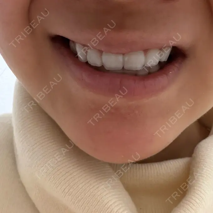 ボトックス（エラ・小顔） 筋肉・美容クリニック AFTER メイン用