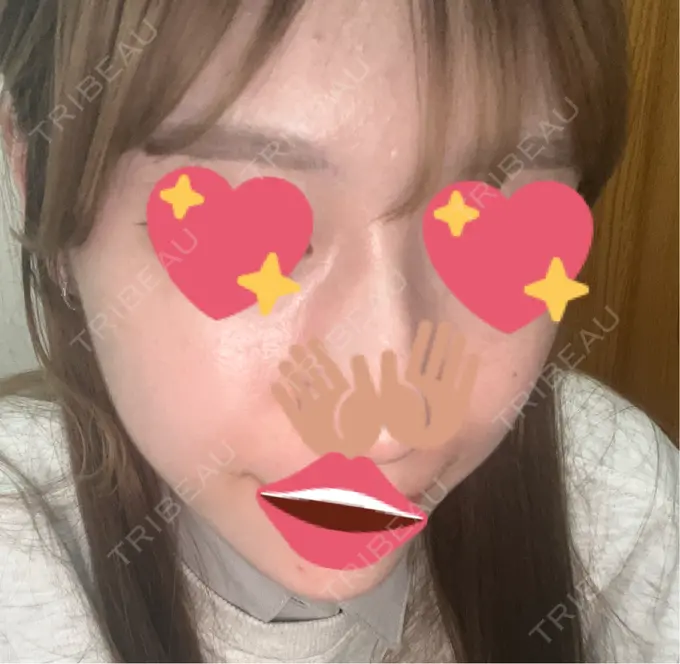 シミ取りレーザー S-Laboクリニック 渋谷院 AFTER メイン用