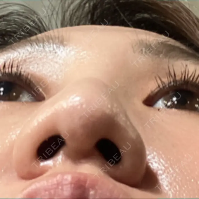 鼻尖形成（切開） / 鼻中隔延長（非切開） ASTRA BEAUTY CLINIC AFTER メイン用