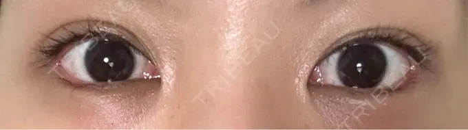 目尻切開 / タレ目形成・グラマラスライン（埋没） LOUIS CLINIC 二子玉川院【ルイクリニック】 DAY 33 メイン用