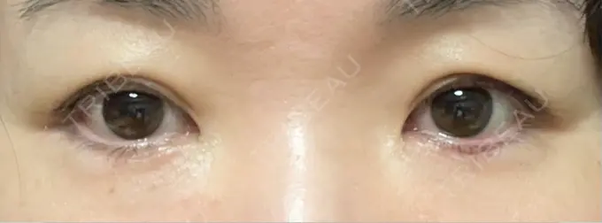 ヒアルロン酸注入（涙袋） 新未来クリニック DAY 2 メイン用