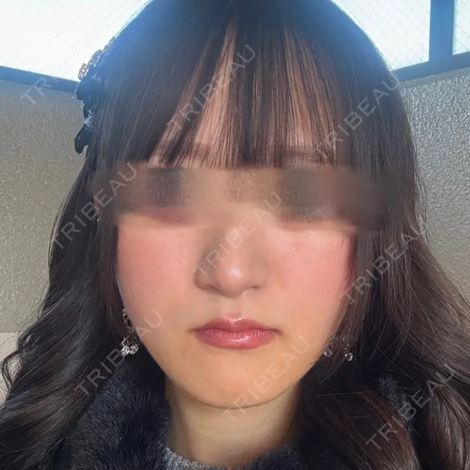 骨切り（あご） 銀座マイアミ美容外科 DAY 247 メイン用