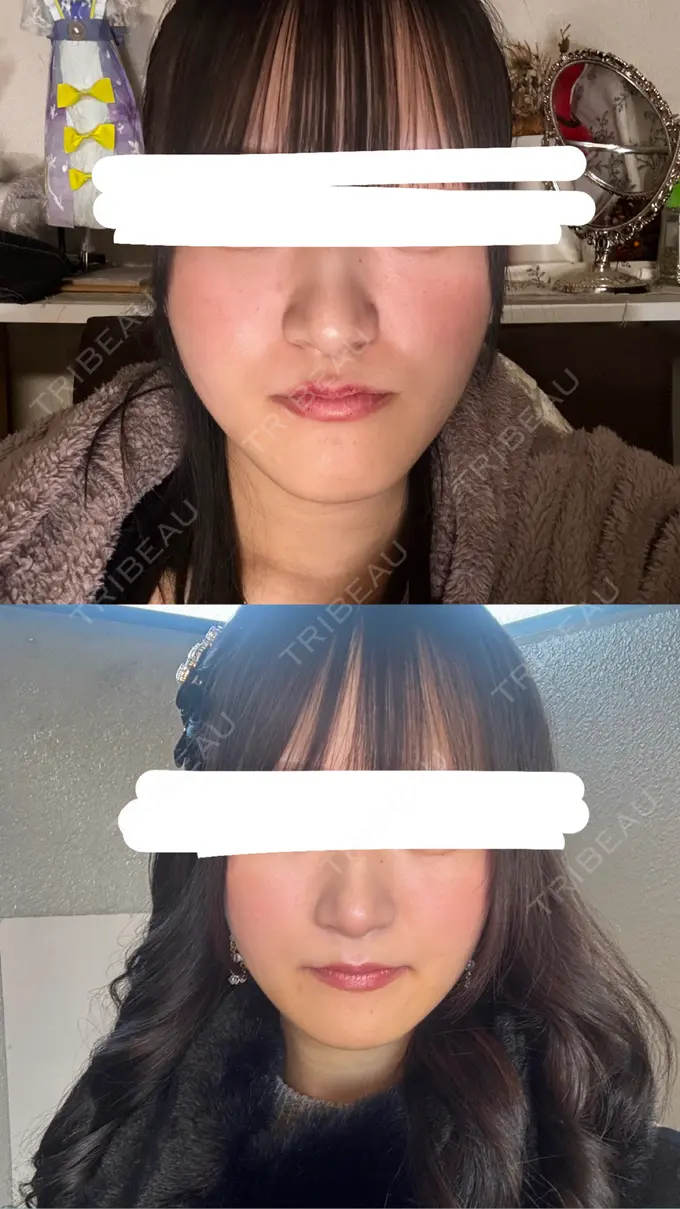 骨切り（あご） 銀座マイアミ美容外科 DAY 247 メイン用