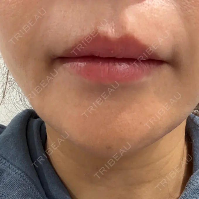 ボトックス（あご） / ボトックス（額） パルム美容クリニック DAY 2 メイン用