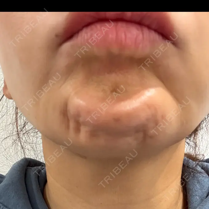 ボトックス（あご） / ボトックス（額） パルム美容クリニック DAY 2 メイン用