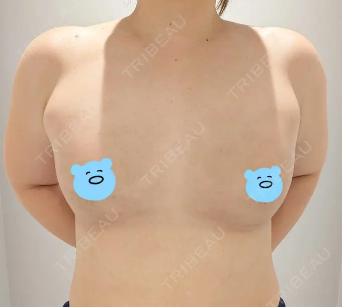 脂肪吸引（脚） / 脂肪吸引（お尻） / 豊胸（脂肪注入） Mods Clinic（モッズクリニック） 名古屋院 DAY 112 メイン用