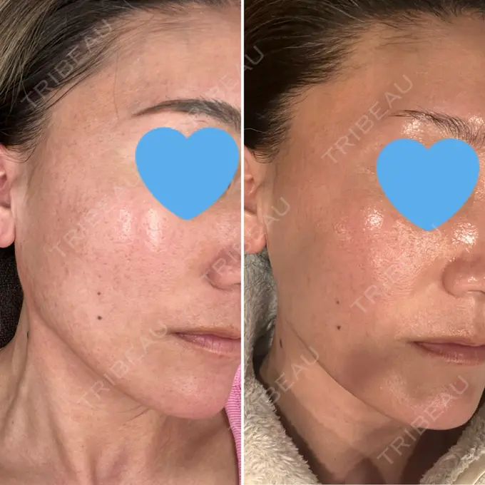 ボトックス（エラ・小顔） / ハイフ（顔） TCB東京中央美容外科 横浜駅前院 AFTER メイン用