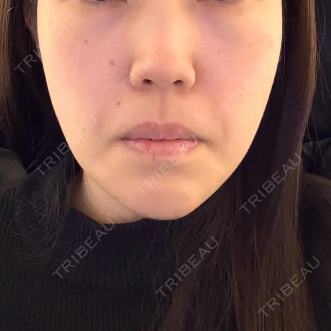 糸リフト / ヒアルロン酸注入（あご） L‘amour clinic Tokyo【ラムールクリニック東京】 DAY 7 メイン用