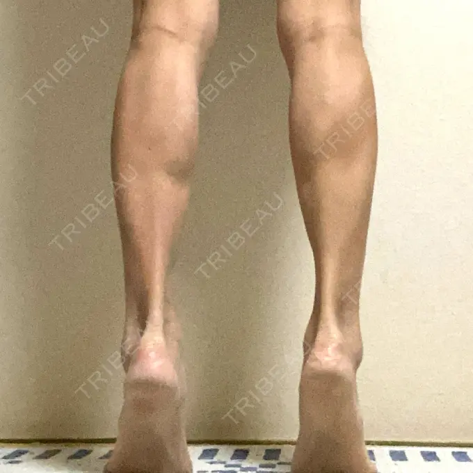 ボトックス（ふくらはぎ） TCB東京中央美容外科 神戸院 DAY 11 メイン用