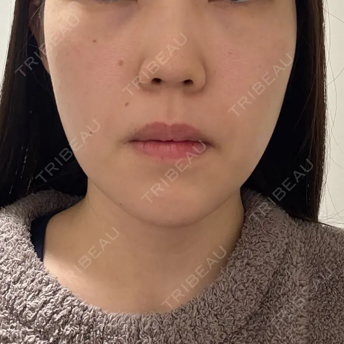 糸リフト / ヒアルロン酸注入（あご） L‘amour clinic Tokyo【ラムールクリニック東京】 DAY 8 メイン用