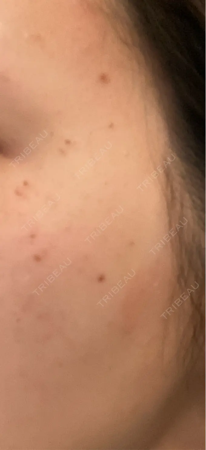 ピーリング（ニキビ・毛穴） / ルメッカ ルラ美容クリニック 静岡院 DAY 1 メイン用