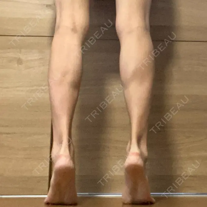 ボトックス（ふくらはぎ） TCB東京中央美容外科 神戸院 DAY 12 メイン用