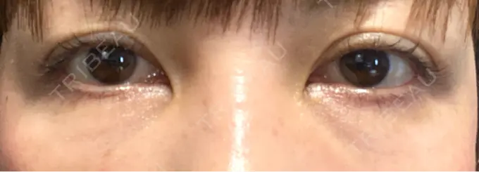 クマ治療 / 下まぶたたるみ取り / ヒアルロン酸注入（目の下） / ボトックス（目尻） TCB東京中央美容外科 神戸院 DAY 69 メイン用