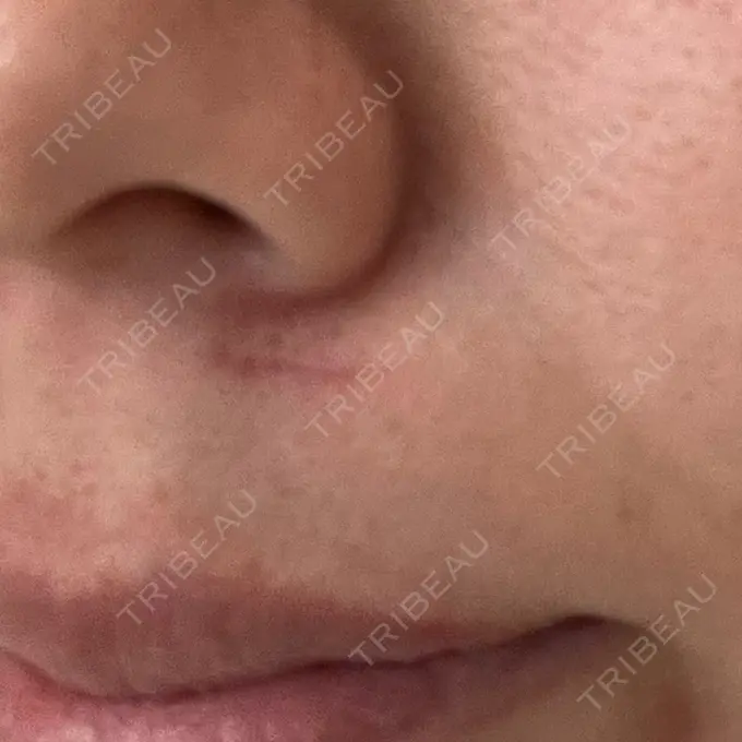 ピーリング（ニキビ・毛穴） / イオン導入 KM新宿クリニック AFTER メイン用