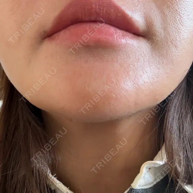 ボトックス（あご） / ボトックス（額） パルム美容クリニック DAY 5 メイン用