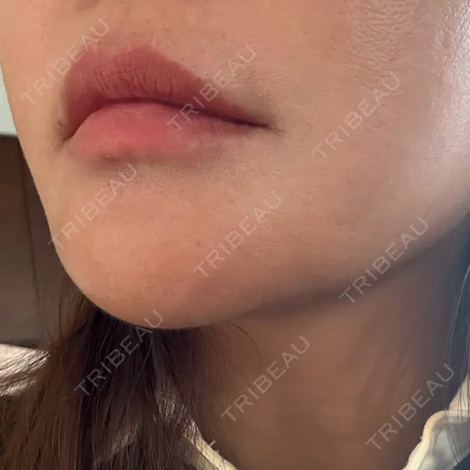 ボトックス（あご） / ボトックス（額） パルム美容クリニック DAY 5 メイン用