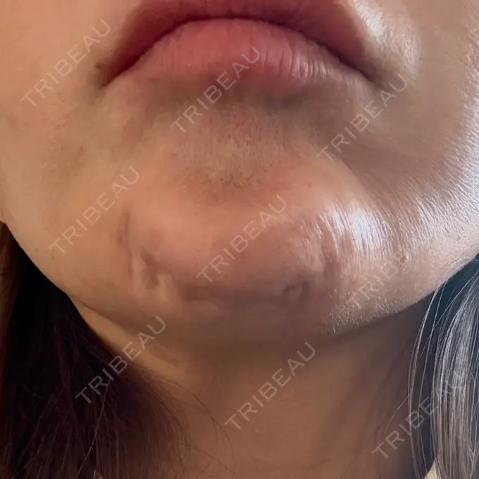 ボトックス（あご） / ボトックス（額） パルム美容クリニック DAY 5 メイン用