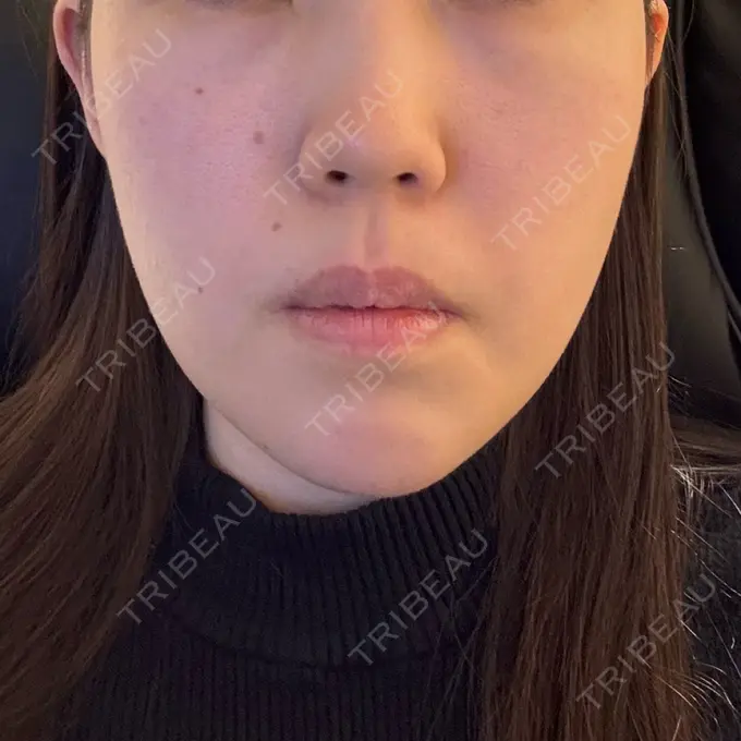 糸リフト / ヒアルロン酸注入（あご） L‘amour clinic Tokyo【ラムールクリニック東京】 DAY 9 メイン用