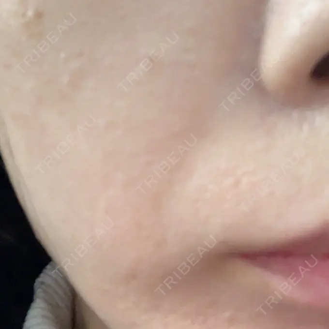 ピーリング（ニキビ・毛穴） 湘南美容クリニック 新橋銀座口院 AFTER メイン用