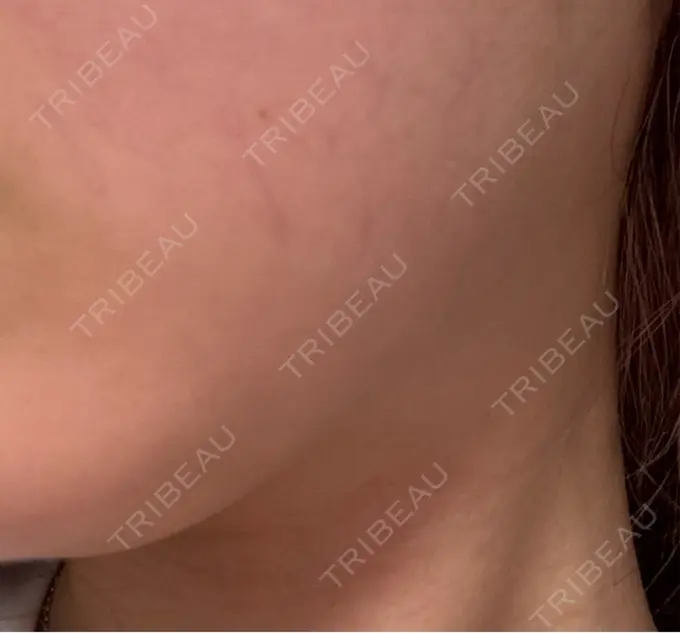 ボトックス（エラ・小顔） / ボトックス（ふくらはぎ） BiBiクリニック DAY 15 メイン用