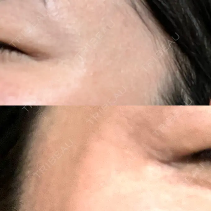 ボトックス（目尻） 湘南美容クリニック 立川院 DAY 29 メイン用