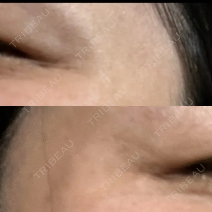 ボトックス（目尻） 湘南美容クリニック 立川院 AFTER メイン用