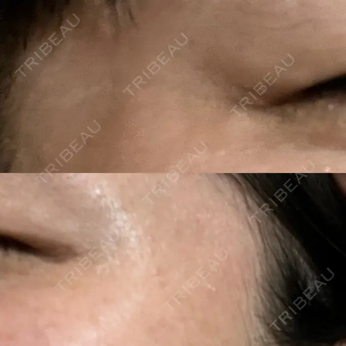 ボトックス（目尻） 湘南美容クリニック 立川院 DAY 28 メイン用