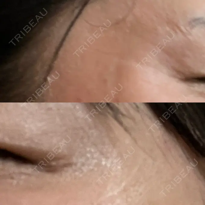 ボトックス（目尻） 湘南美容クリニック 立川院 DAY 26 メイン用