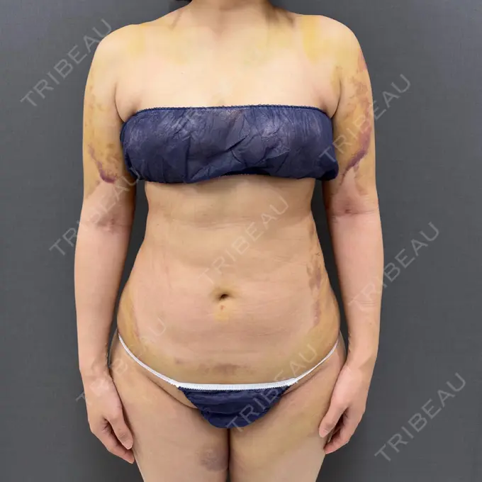 脂肪吸引（二の腕） / 脂肪吸引（お腹） / 脂肪吸引（腰） / 脂肪吸引（背中） ルーチェクリニック 銀座院 AFTER メイン用