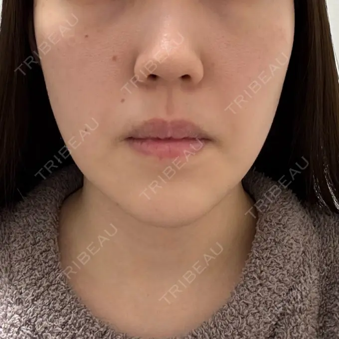 糸リフト / ヒアルロン酸注入（あご） L‘amour clinic Tokyo【ラムールクリニック東京】 DAY 11 メイン用