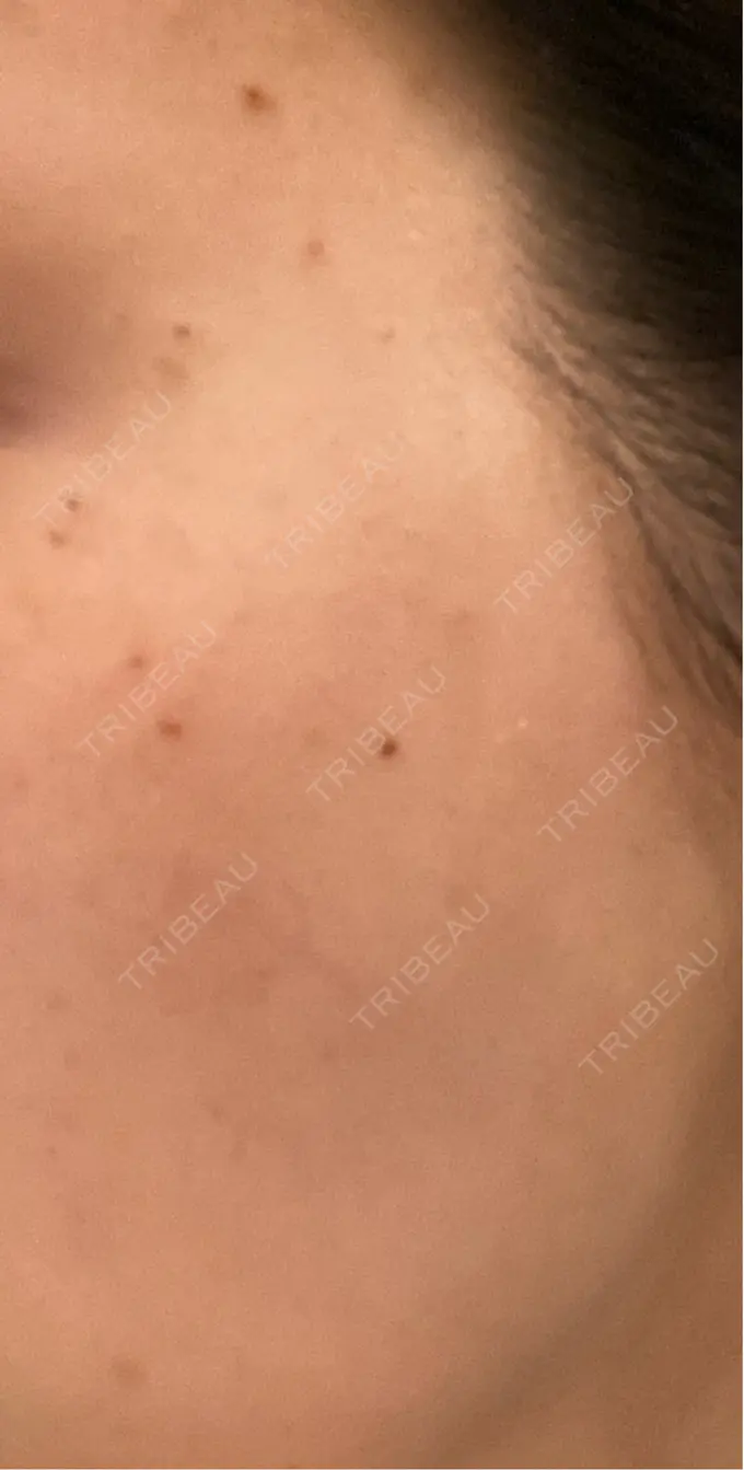 ピーリング（ニキビ・毛穴） / ルメッカ ルラ美容クリニック 静岡院 DAY 2 メイン用