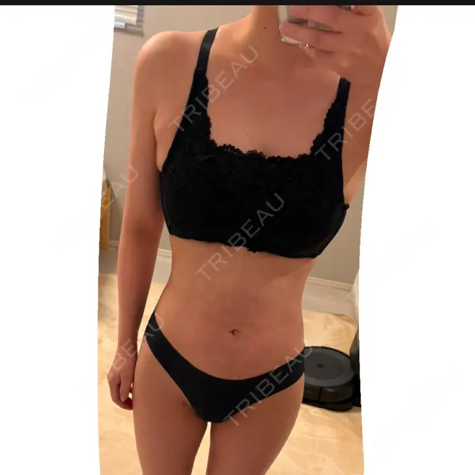 脂肪吸引（二の腕） / 脂肪吸引（腰） / 脂肪吸引（肩） / 医療脱毛（お腹） Mods Clinic（モッズクリニック） 大阪院 DAY 103 メイン用