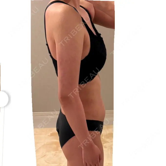 脂肪吸引（二の腕） / 脂肪吸引（腰） / 脂肪吸引（肩） / 医療脱毛（お腹） Mods Clinic（モッズクリニック） 大阪院 DAY 103 メイン用