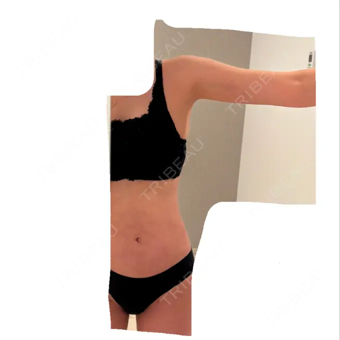 脂肪吸引（二の腕） / 脂肪吸引（腰） / 脂肪吸引（肩） / 医療脱毛（お腹） Mods Clinic（モッズクリニック） 大阪院 DAY 103 メイン用