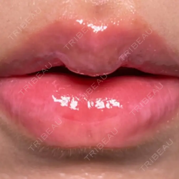 その他（口元） R Beauty CLINIC 銀座院 AFTER メイン用