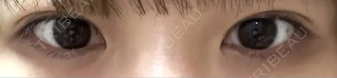 二重埋没 / 自然癒着法 Brandnew Beauty Clinic AFTER メイン用