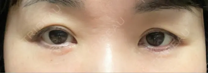 ヒアルロン酸注入（涙袋） 新未来クリニック DAY 7 メイン用