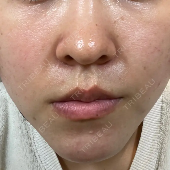 毛穴洗浄（ハイドラフェイシャルなど） 東京素肌クリニック 銀座本院 DAY 4 メイン用