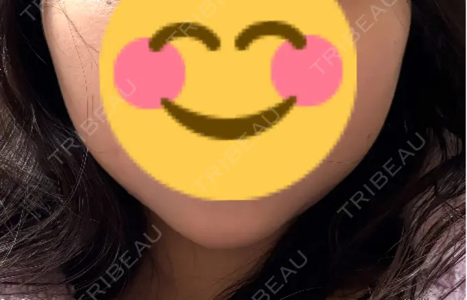 糸リフト / バッカルファット除去 / その他（輪郭） MEMOTO CLINIC 名古屋 DAY 6 メイン用