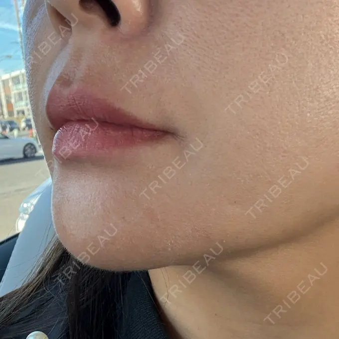 ボトックス（あご） / ボトックス（額） パルム美容クリニック DAY 8 メイン用