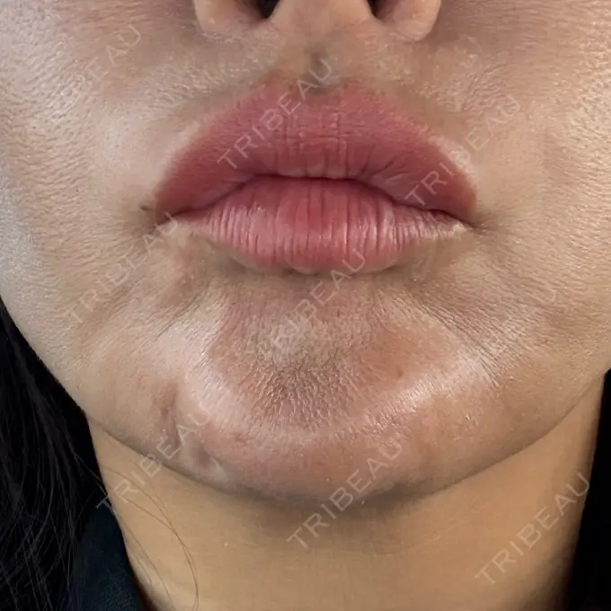 ボトックス（あご） / ボトックス（額） パルム美容クリニック DAY 8 メイン用