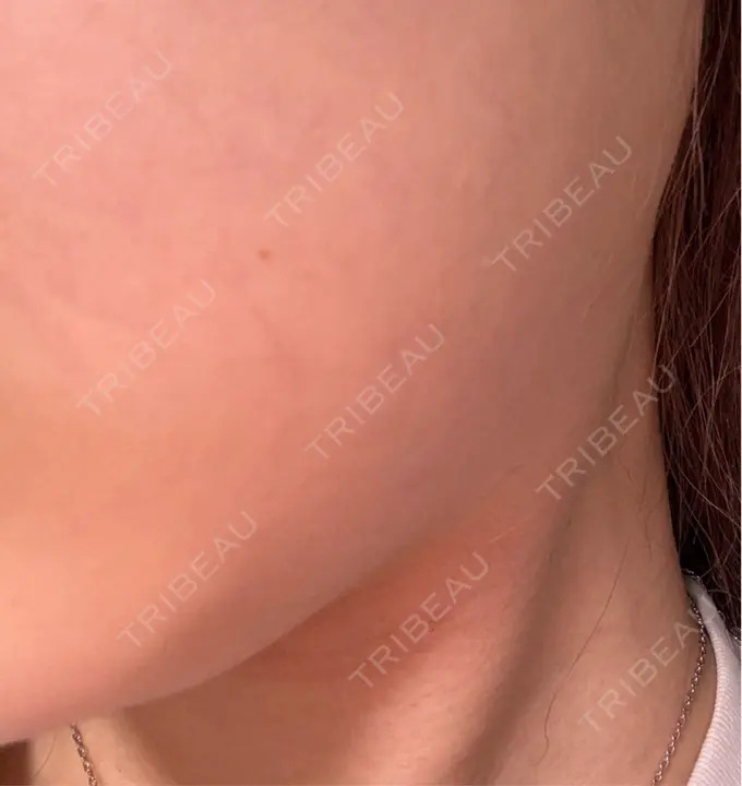 ボトックス（エラ・小顔） / ボトックス（ふくらはぎ） BiBiクリニック DAY 16 メイン用