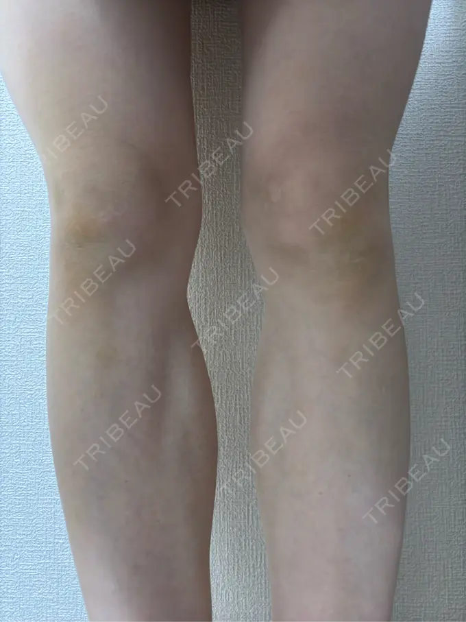 ボトックス（エラ・小顔） / ボトックス（ふくらはぎ） BiBiクリニック DAY 16 メイン用