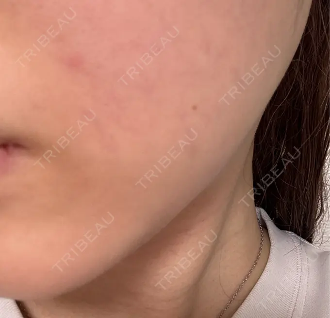 ボトックス（エラ・小顔） / ボトックス（ふくらはぎ） BiBiクリニック DAY 17 メイン用