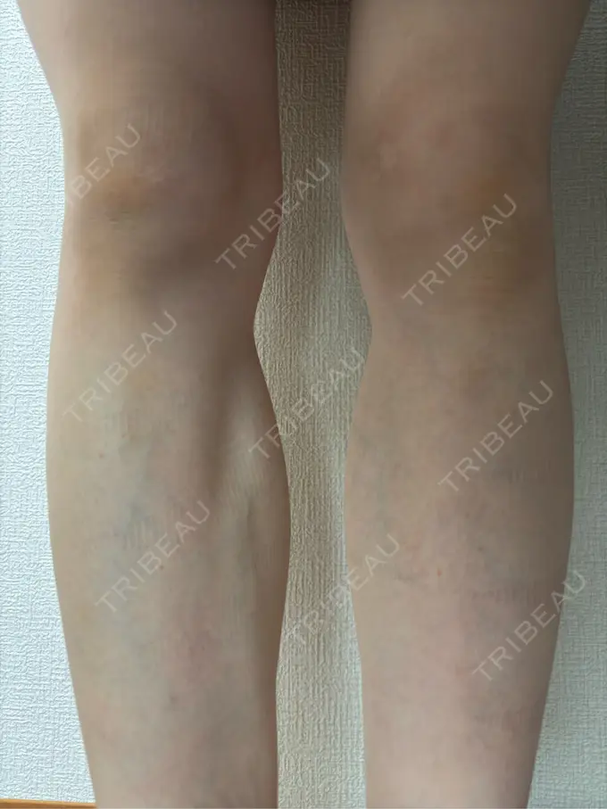 ボトックス（エラ・小顔） / ボトックス（ふくらはぎ） BiBiクリニック DAY 17 メイン用