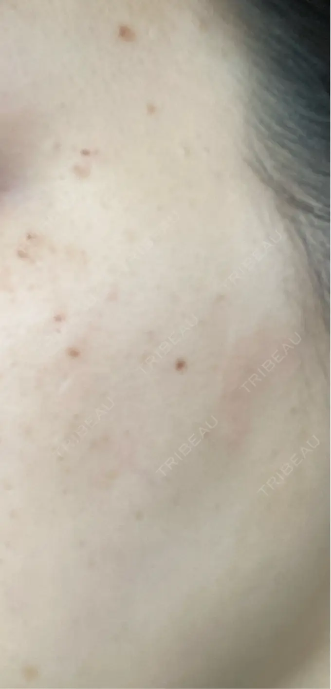 ピーリング（ニキビ・毛穴） / ルメッカ ルラ美容クリニック 静岡院 DAY 3 メイン用