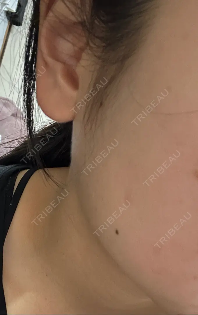 ボトックス（あご） / ボトックス（エラ・小顔） / 脂肪溶解注射（顔） / その他（鼻） Zetith Beauty Clinic 福岡院 DAY 0 メイン用