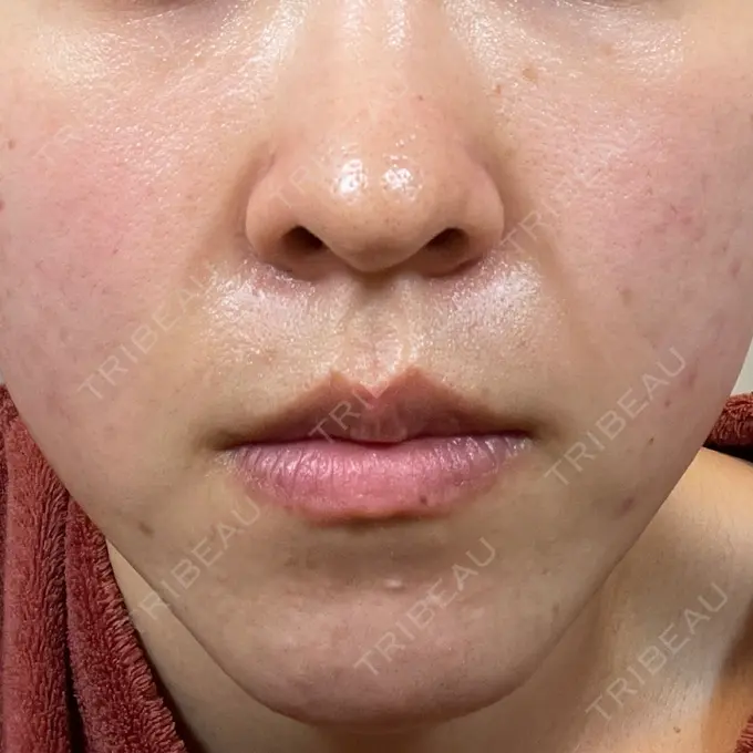 毛穴洗浄（ハイドラフェイシャルなど） 東京素肌クリニック 銀座本院 DAY 5 メイン用