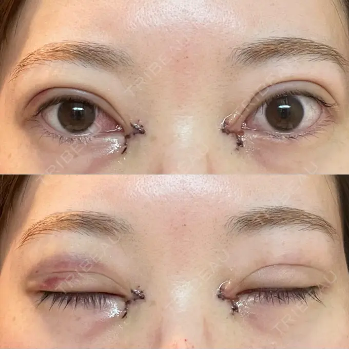 二重埋没 / 目頭切開 アリエル美容クリニック 郡山院 DAY 1 メイン用